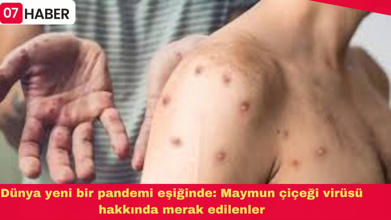 Dünya yeni bir pandemi eşiğinde: Maymun çiçeği virüsü hakkında merak edilenler