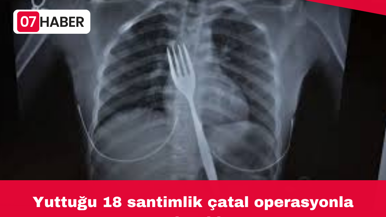 Yuttuğu 18 santimlik çatal operasyonla çıkarıldı